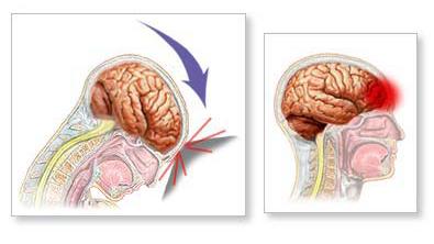 TBI Therapy – Colorado Center for Hyperbaric Medicine